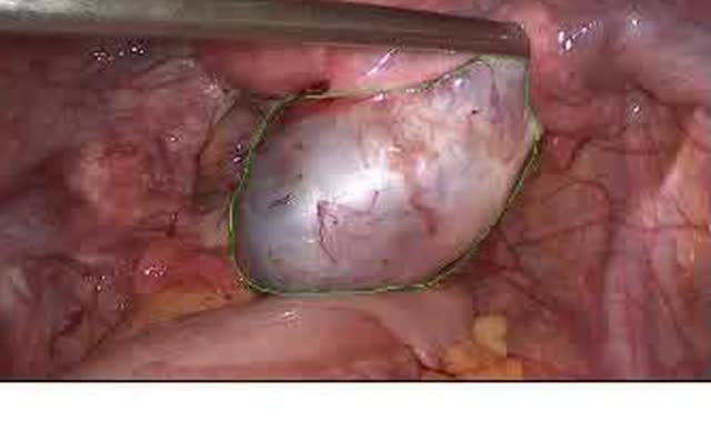 Endometriosis of the ovary as seen during laparoscopy.
