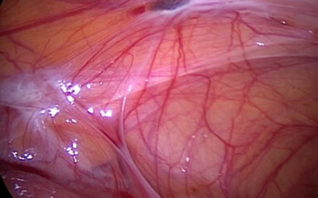 A superficial endometriosis lesion on the peritoneum, seen during laparoscopy.